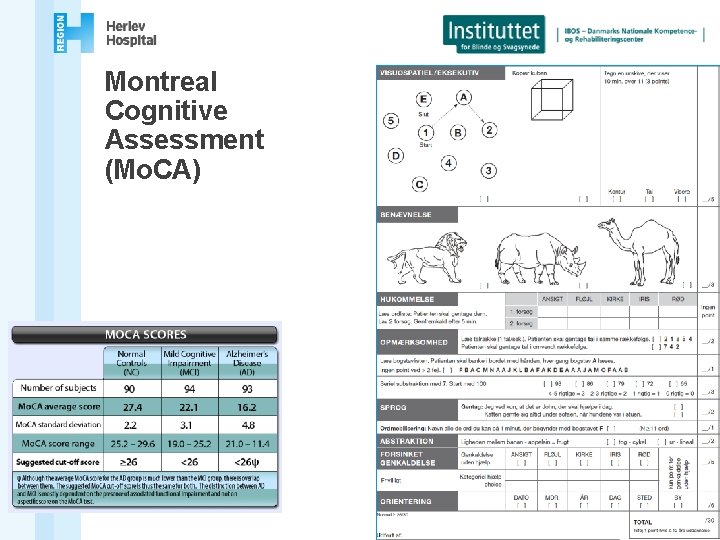 Montreal Cognitive Assessment (Mo. CA) 