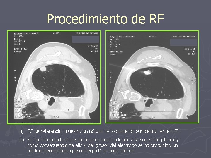 Procedimiento de RF a) TC de referencia, muestra un nódulo de localización subpleural en