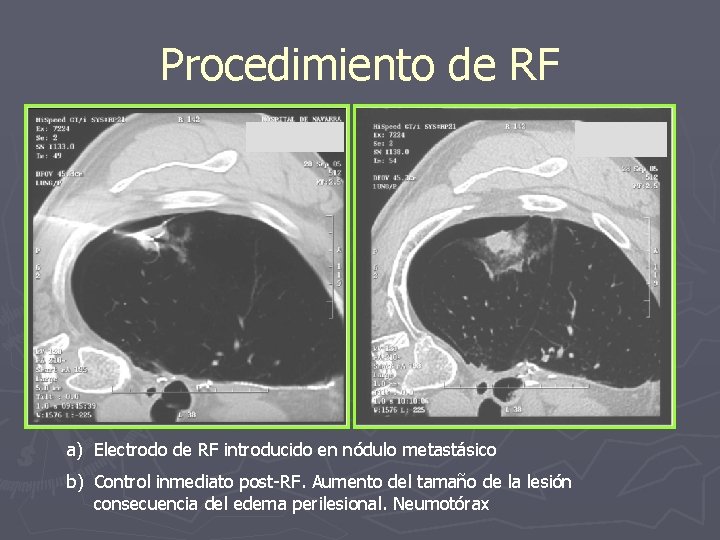 Procedimiento de RF a) Electrodo de RF introducido en nódulo metastásico b) Control inmediato
