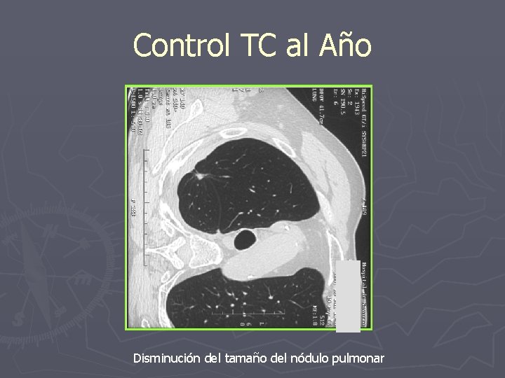 Control TC al Año Disminución del tamaño del nódulo pulmonar 