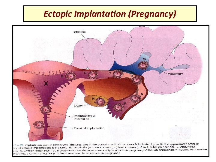 Ectopic Implantation (Pregnancy) 