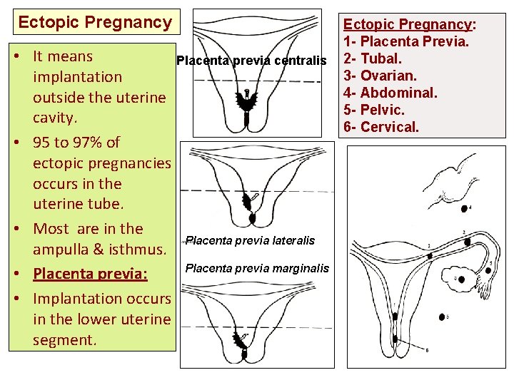 Ectopic Pregnancy • It means Placenta previa centralis implantation outside the uterine cavity. •
