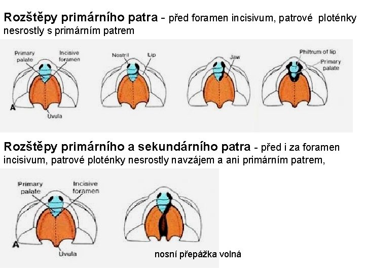 Rozštěpy primárního patra - před foramen incisivum, patrové ploténky nesrostly s primárním patrem Rozštěpy