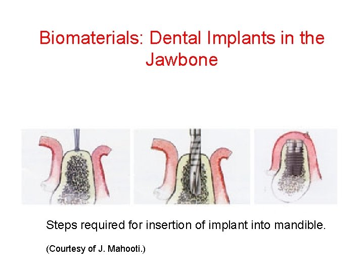Biomaterials: Dental Implants in the Jawbone Steps required for insertion of implant into mandible.