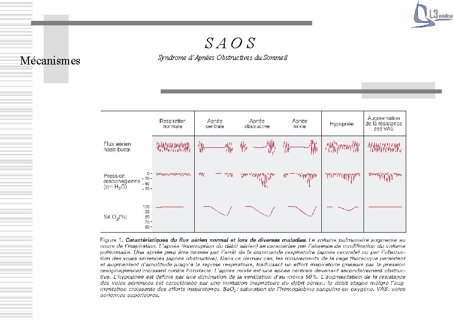 SAOS Mécanismes Syndrome d’Apnées Obstructives du Sommeil 