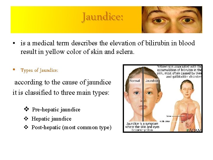 Jaundice: • is a medical term describes the elevation of bilirubin in blood result