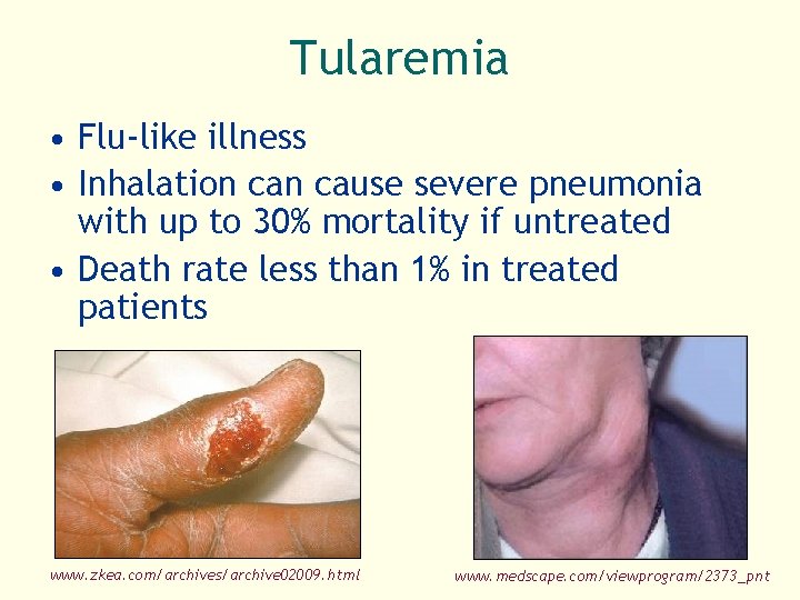 Tularemia • Flu-like illness • Inhalation cause severe pneumonia with up to 30% mortality