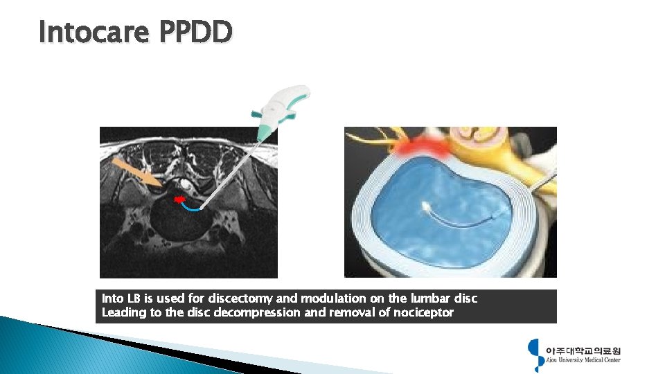 Intocare PPDD Ablation through Into Series Into LB is used for discectomy and modulation