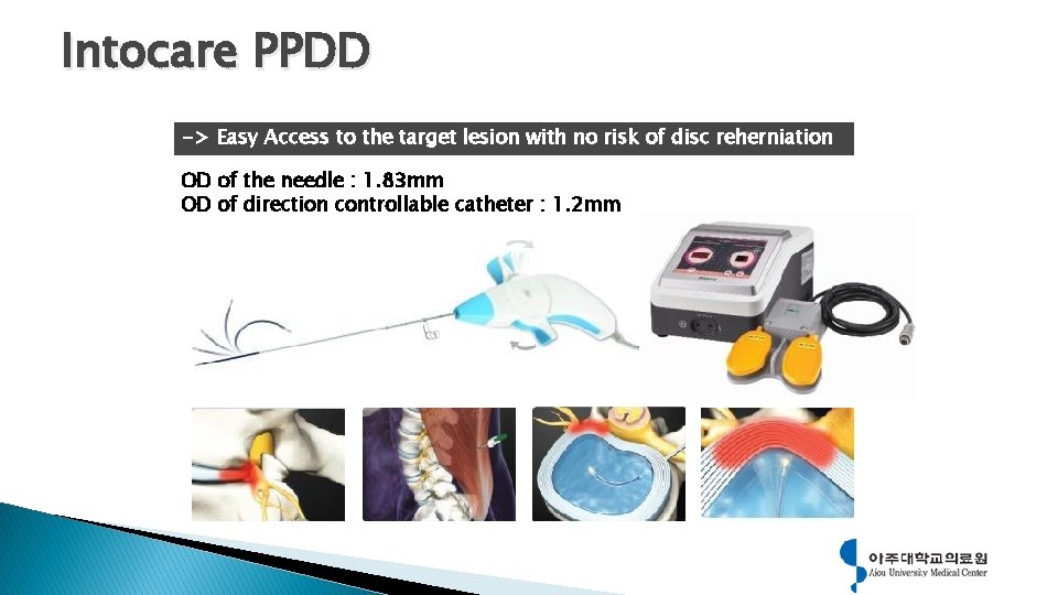 Intocare PPDD -> Easy Access to the target lesion with no risk of disc