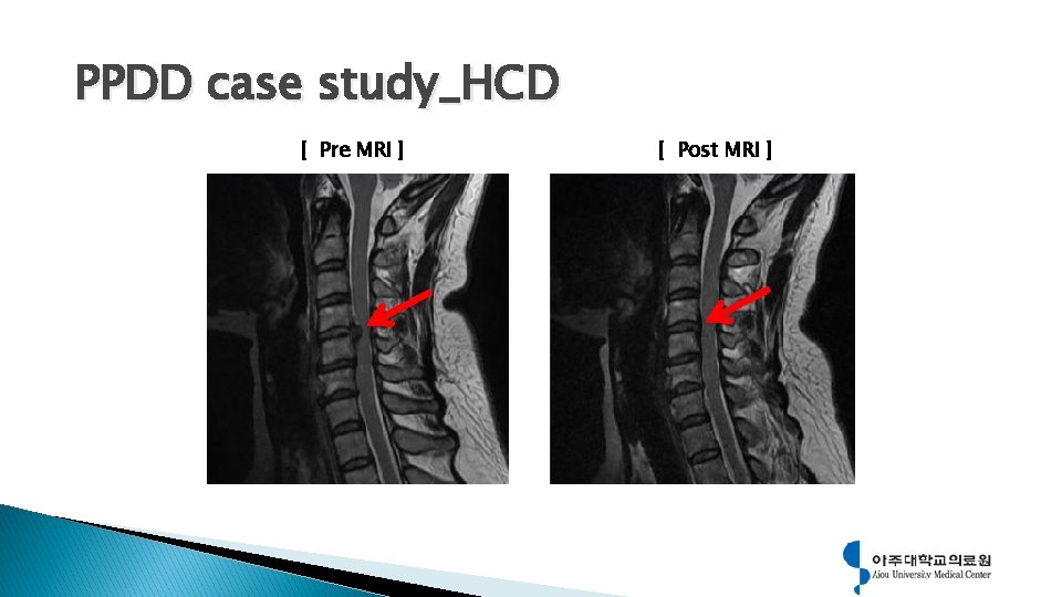 PPDD case study_HCD [ Pre MRI ] [ Post MRI ] 