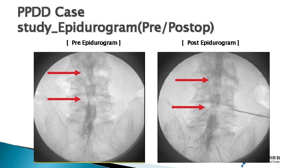 PPDD Case study_Epidurogram(Pre/Postop) [ Pre Epidurogram ] [ Post Epidurogram ] 