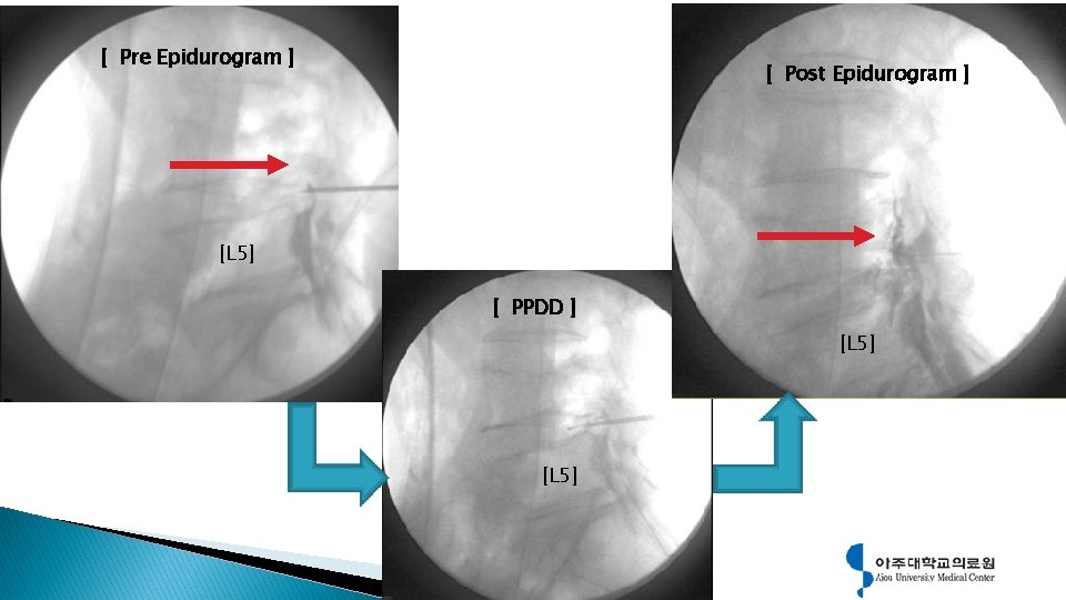 [ Pre Epidurogram ] [ Post Epidurogram ] [L 5] [ PPDD ] [L
