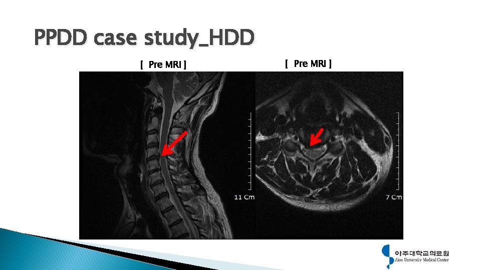 PPDD case study_HDD [ Pre MRI ] 