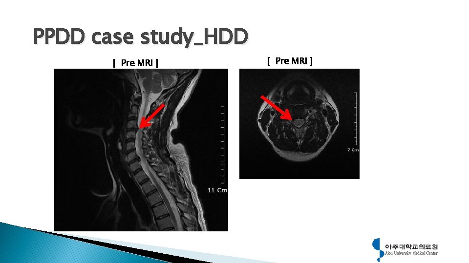 PPDD case study_HDD [ Pre MRI ] 
