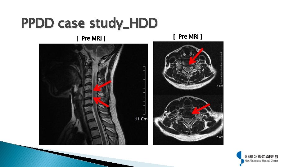 PPDD case study_HDD [ Pre MRI ] 