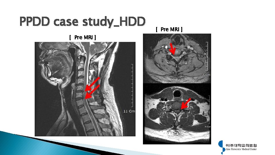 PPDD case study_HDD [ Pre MRI ] 