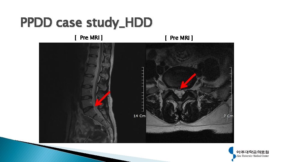 PPDD case study_HDD [ Pre MRI ] 