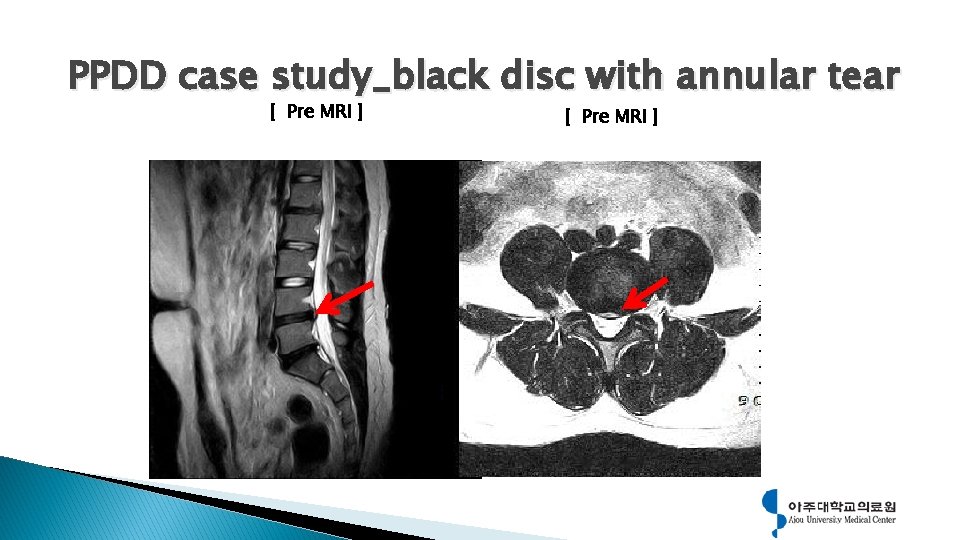 PPDD case study_black disc with annular tear [ Pre MRI ] 