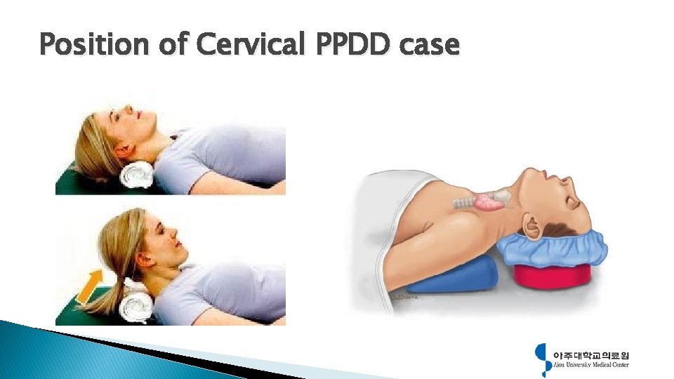 Position of Cervical PPDD case 