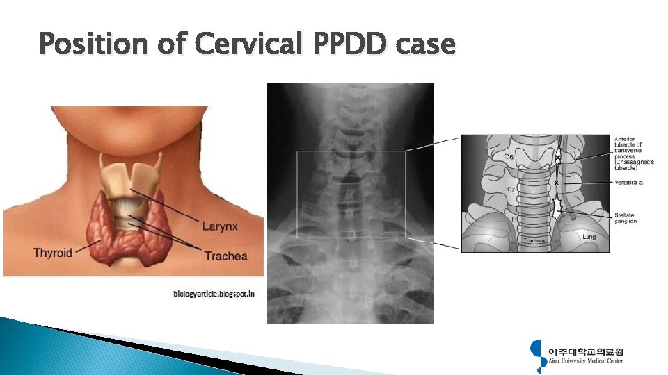 Position of Cervical PPDD case 