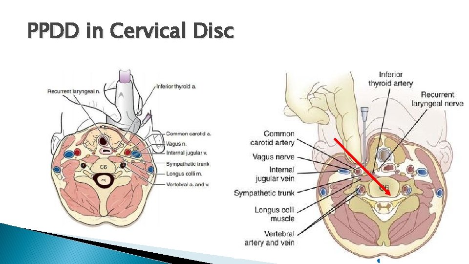 PPDD in Cervical Disc 