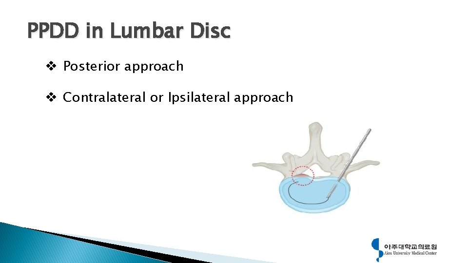 PPDD in Lumbar Disc v Posterior approach v Contralateral or Ipsilateral approach 