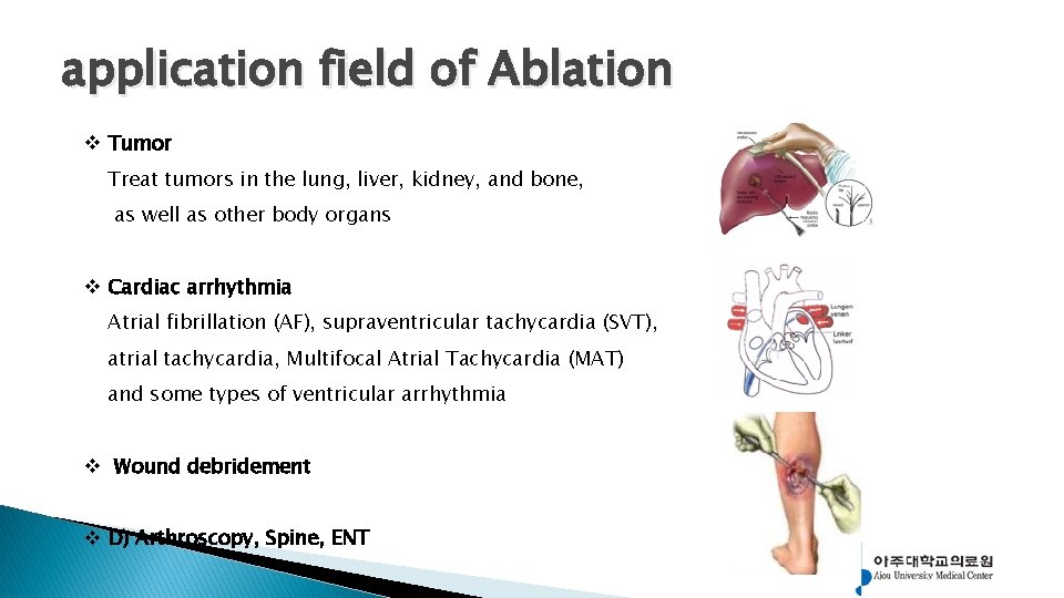 application field of Ablation v Tumor Treat tumors in the lung, liver, kidney, and