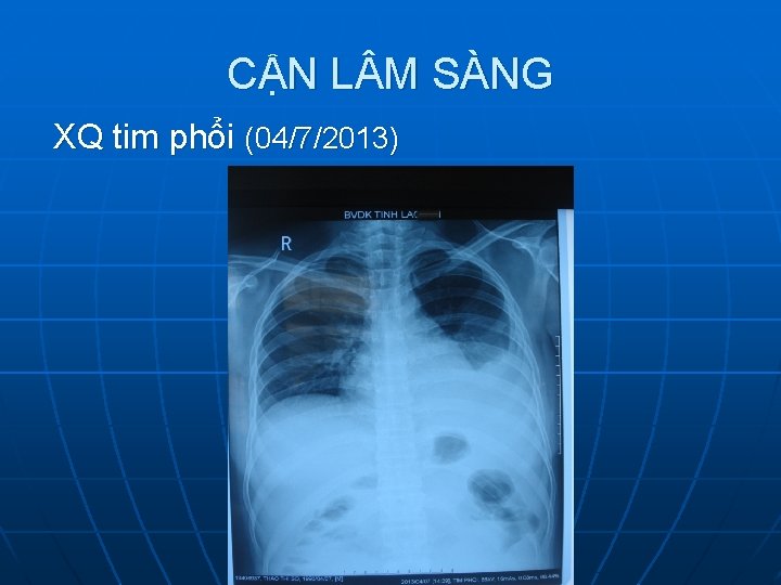 CẬN L M SÀNG XQ tim phổi (04/7/2013) 