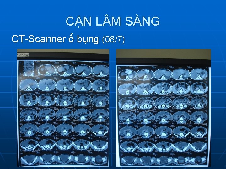 CẬN L M SÀNG CT-Scanner ổ bụng (08/7) 