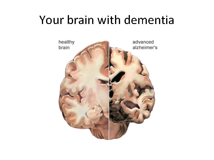 Your brain with dementia 