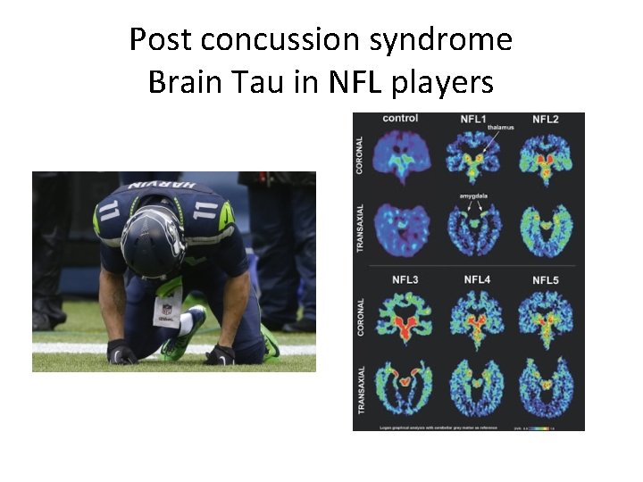 Post concussion syndrome Brain Tau in NFL players 