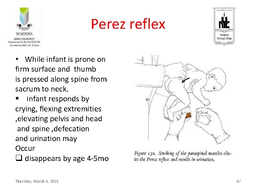 Perez reflex • While infant is prone on firm surface and thumb is pressed