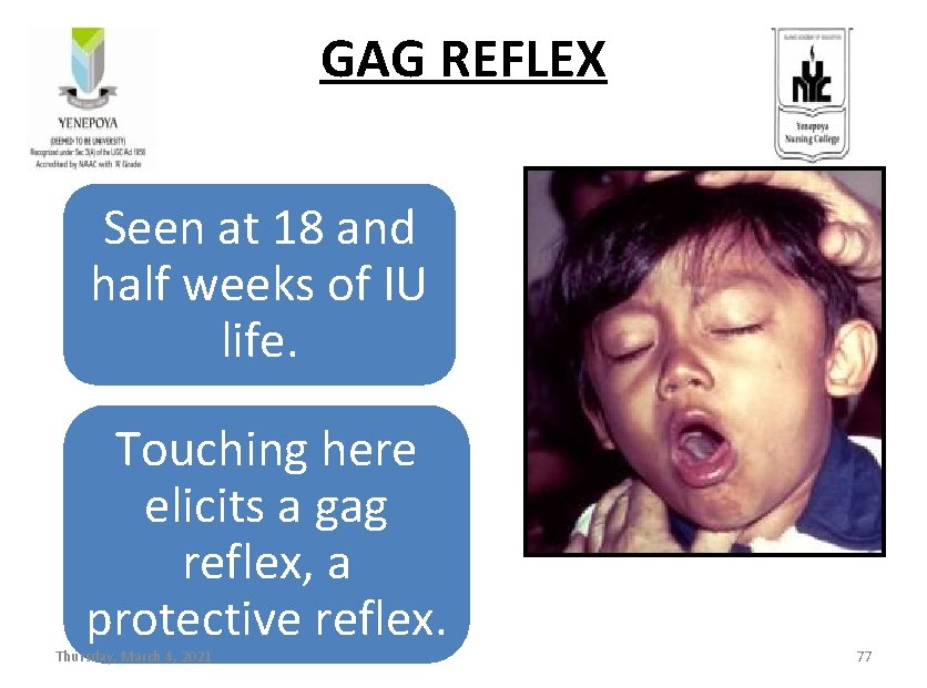 GAG REFLEX Seen at 18 and half weeks of IU life. Touching here elicits