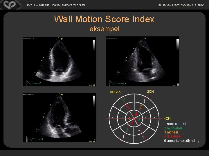 Ekko 1 – kursus i basal ekkokardiografi © Dansk Cardiologisk Selskab Wall Motion Score