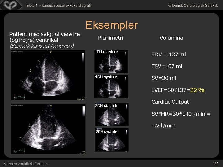 Ekko 1 – kursus i basal ekkokardiografi Patient med svigt af venstre (og højre)