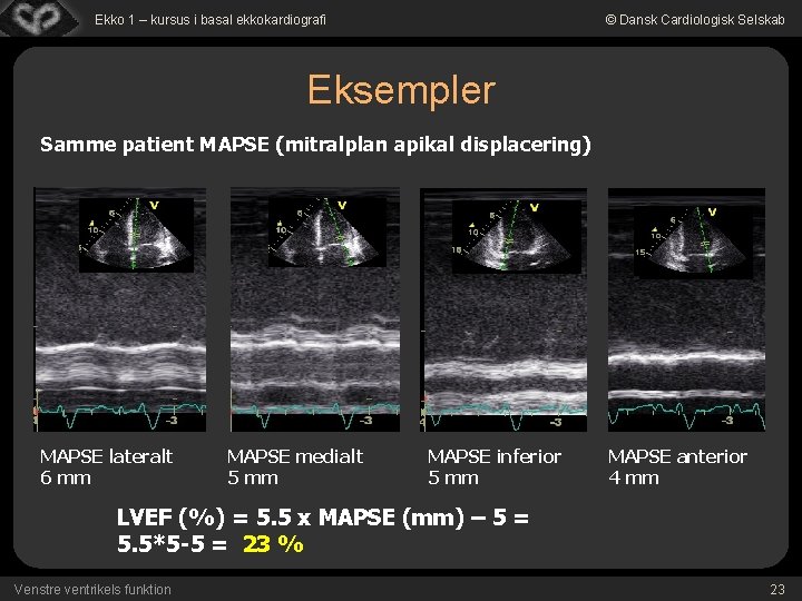 Ekko 1 – kursus i basal ekkokardiografi © Dansk Cardiologisk Selskab Eksempler Samme patient