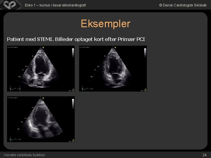 Ekko 1 – kursus i basal ekkokardiografi © Dansk Cardiologisk Selskab Eksempler Patient med