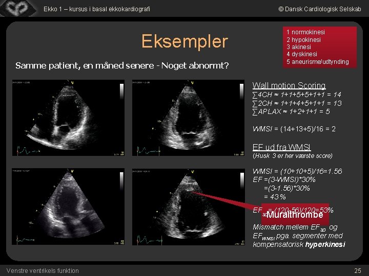 Ekko 1 – kursus i basal ekkokardiografi © Dansk Cardiologisk Selskab 1 normokinesi 2