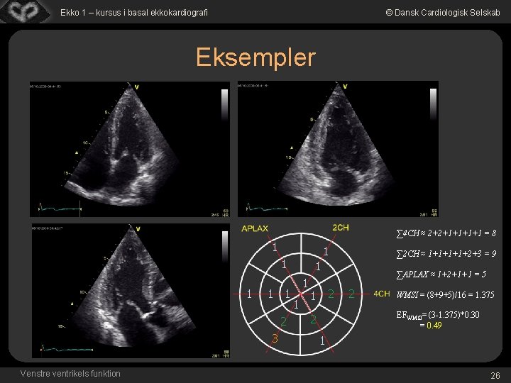 Ekko 1 – kursus i basal ekkokardiografi © Dansk Cardiologisk Selskab Eksempler ∑ 4