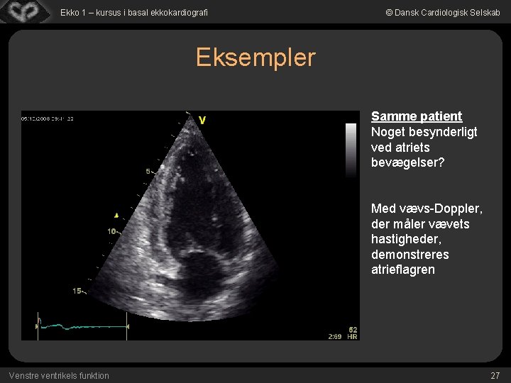 Ekko 1 – kursus i basal ekkokardiografi © Dansk Cardiologisk Selskab Eksempler Samme patient