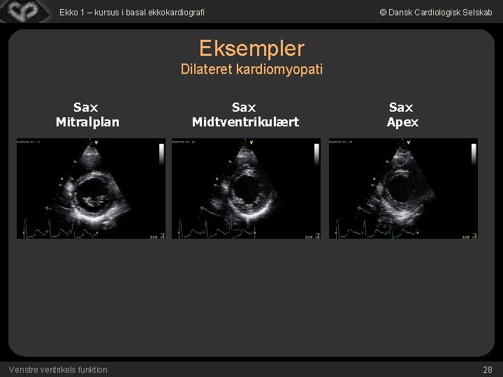 Ekko 1 – kursus i basal ekkokardiografi © Dansk Cardiologisk Selskab Eksempler Dilateret kardiomyopati