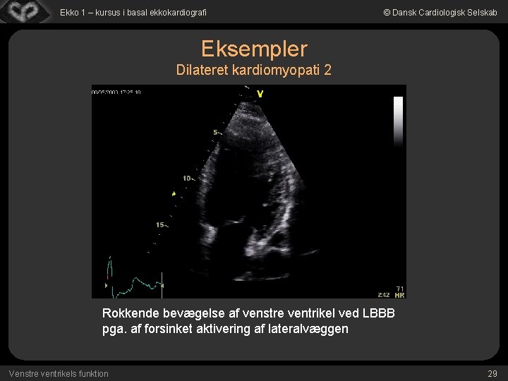 Ekko 1 – kursus i basal ekkokardiografi © Dansk Cardiologisk Selskab Eksempler Dilateret kardiomyopati