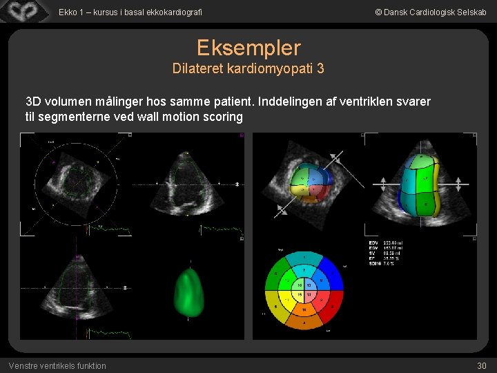 Ekko 1 – kursus i basal ekkokardiografi © Dansk Cardiologisk Selskab Eksempler Dilateret kardiomyopati