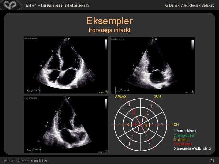 Ekko 1 – kursus i basal ekkokardiografi © Dansk Cardiologisk Selskab Eksempler Forvægs infarkt