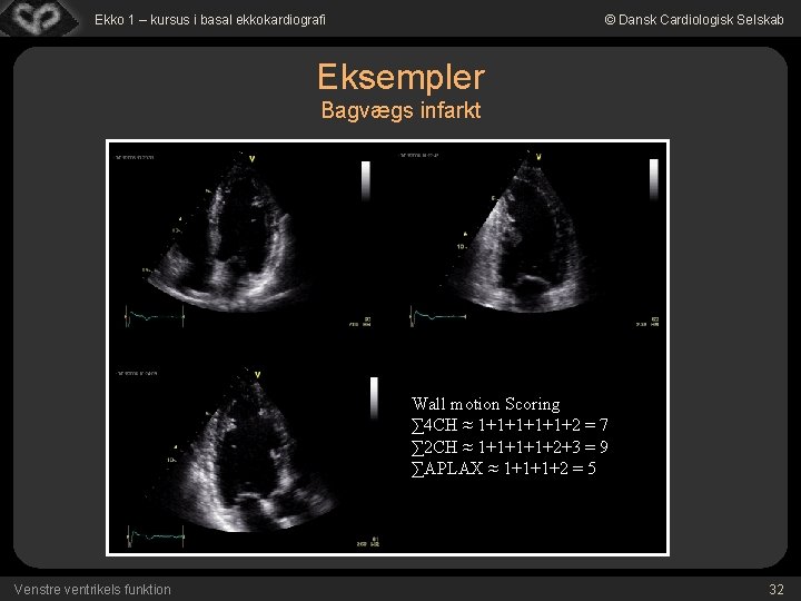 Ekko 1 – kursus i basal ekkokardiografi © Dansk Cardiologisk Selskab Eksempler Bagvægs infarkt
