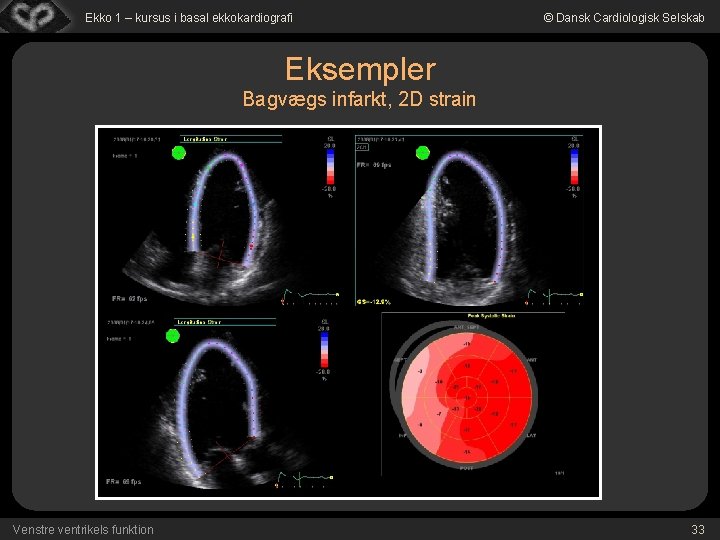 Ekko 1 – kursus i basal ekkokardiografi © Dansk Cardiologisk Selskab Eksempler Bagvægs infarkt,