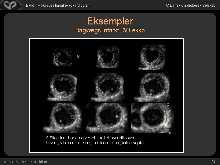 Ekko 1 – kursus i basal ekkokardiografi © Dansk Cardiologisk Selskab Eksempler Bagvægs infarkt,