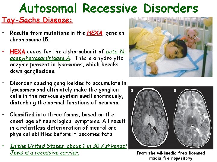 Autosomal Recessive Disorders Tay-Sachs Disease: • Results from mutations in the HEXA gene on