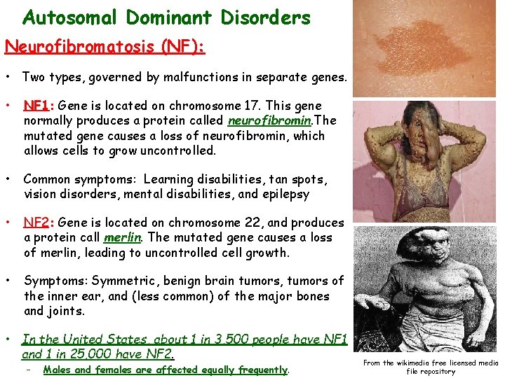 Autosomal Dominant Disorders Neurofibromatosis (NF): • Two types, governed by malfunctions in separate genes.