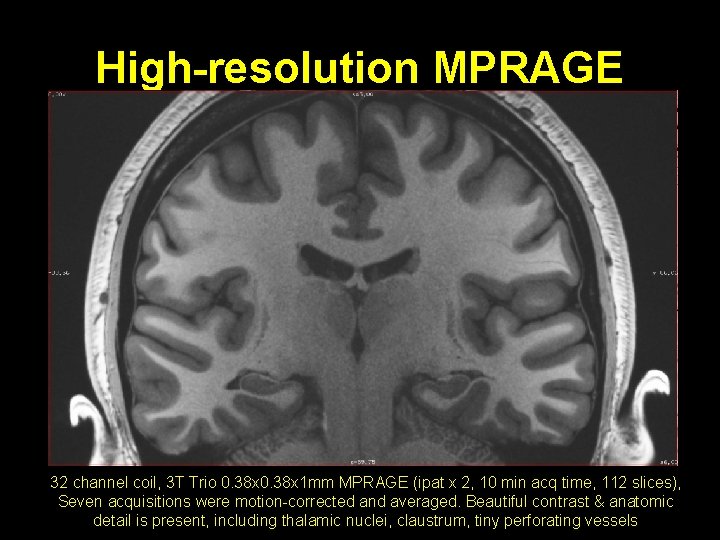High-resolution MPRAGE 32 channel coil, 3 T Trio 0. 38 x 1 mm MPRAGE High-resolution MPRAGE 32 channel coil, 3 T Trio 0. 38 x 1 mm MPRAGE